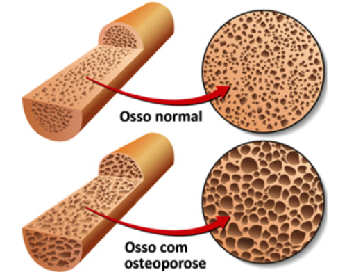 osso osteoporose